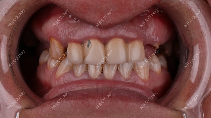 Internal Sinus Lifting special case